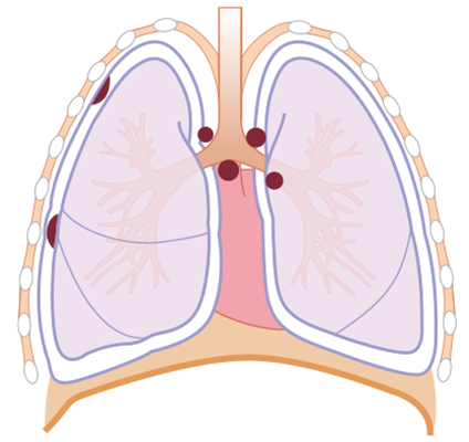 胸膜中皮腫の病期 Ⅲ期A期の図
