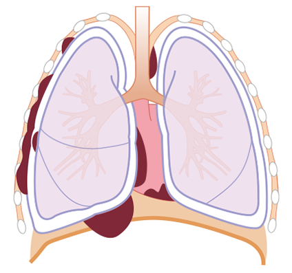 胸膜中皮腫の病期 Ⅲ期B期の図