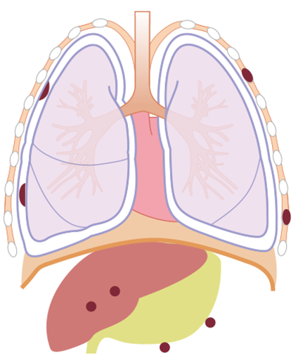 胸膜中皮腫の病期 Ⅳ期の図