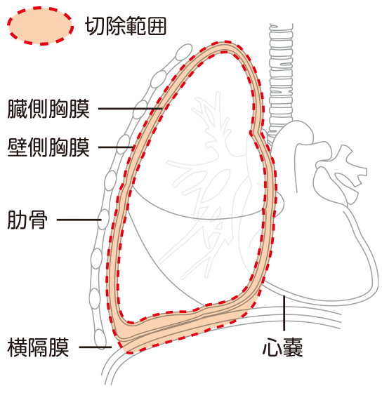 胸膜切除・肺剥皮術（P/D）