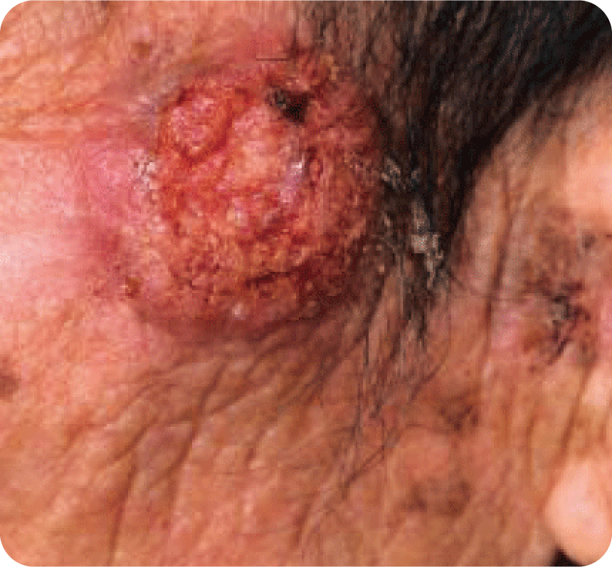 有棘細胞がんの写真