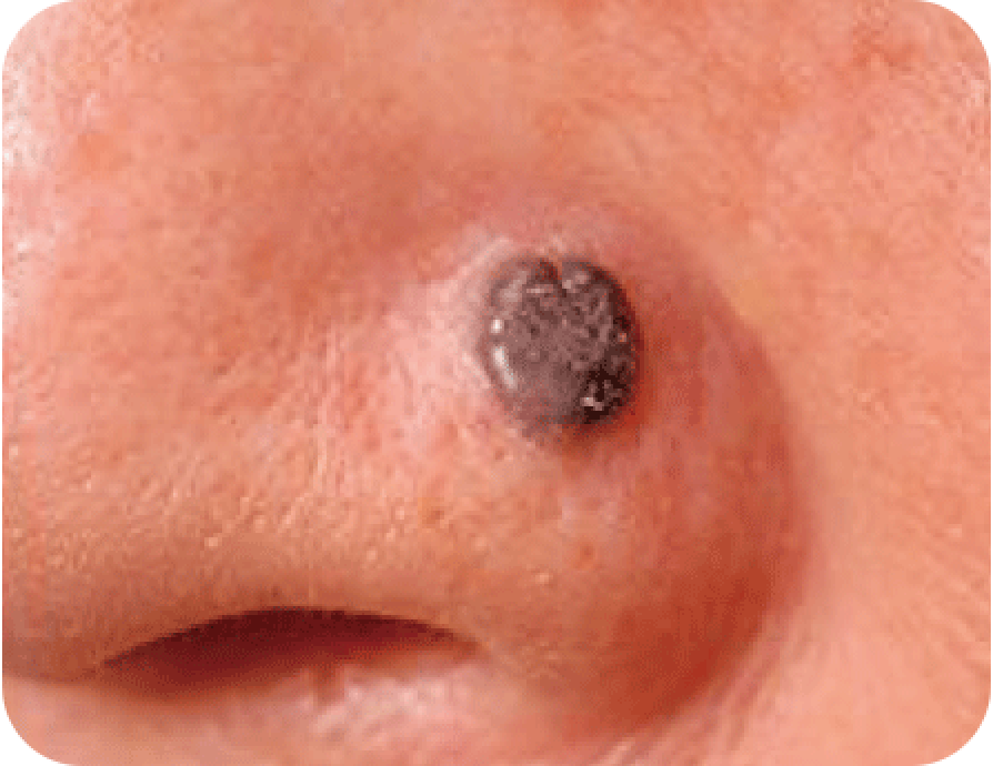 基底細胞がんの写真