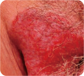 乳房外パジェット病の写真