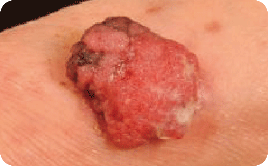 皮膚付属器がんの写真