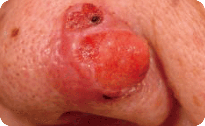 皮膚付属器がんの写真