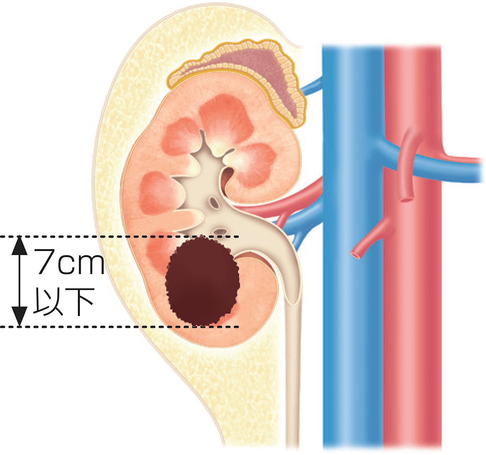 腎細胞がんの病期分類Ⅰ期の図