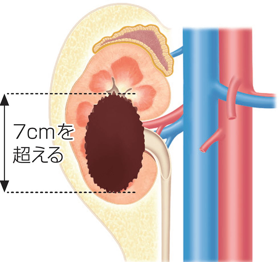 腎細胞がんの病期分類Ⅱ期の図
