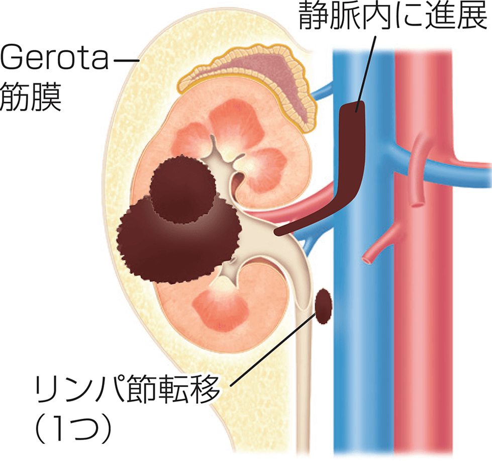 腎細胞がんの病期分類Ⅲ期の図