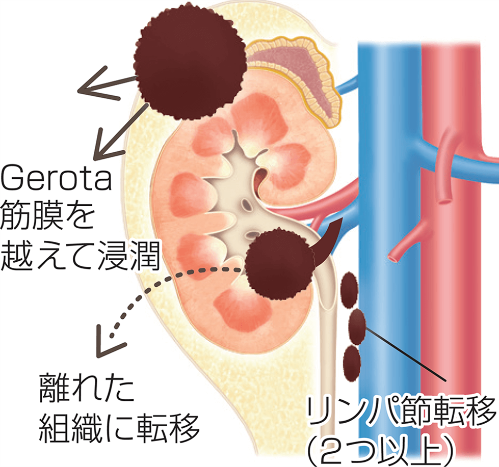腎細胞がんの病期分類Ⅳ期の図