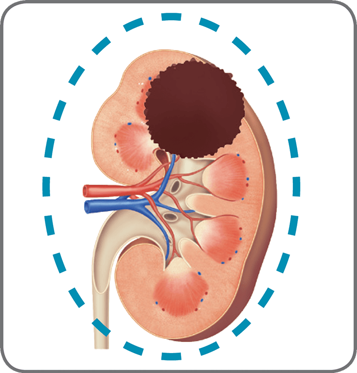 根治的腎摘除術