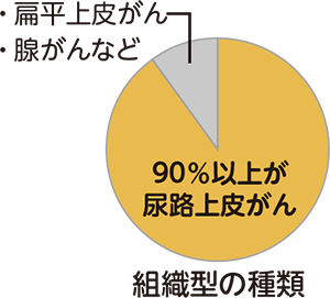 尿路にできるがんの組織型