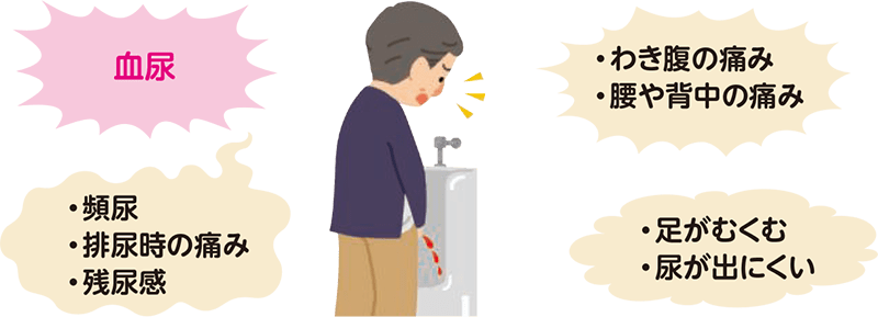 尿路上皮がんの主な症状