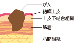 筋層浸潤性がん