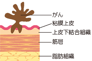 筋層非浸潤性がん