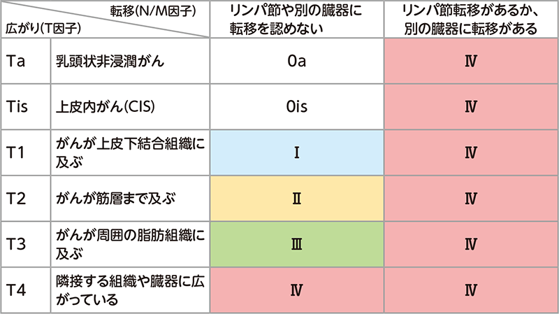 腎盂・尿管がんの病期（ステージ）分類