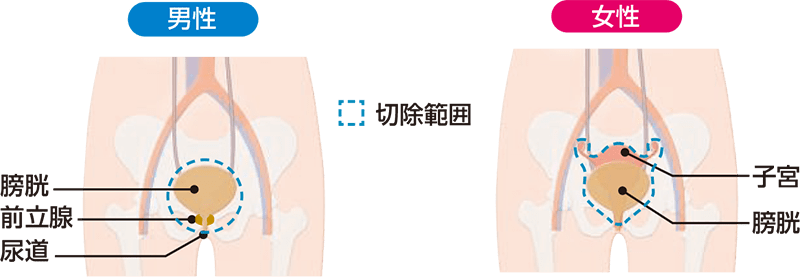 膀胱全摘除術による切除範囲
