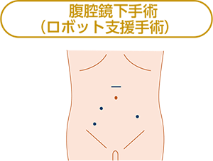 腹腔鏡下手術（ロボット支援手術）