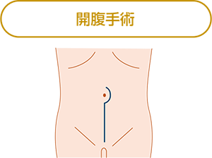 開腹手術