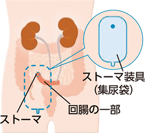 回腸導管造設術