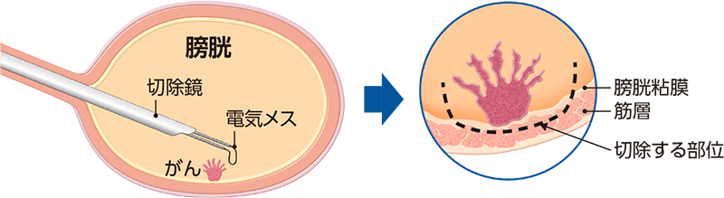 経尿道的膀胱腫瘍切除術