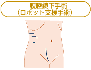 腹腔鏡下手術
