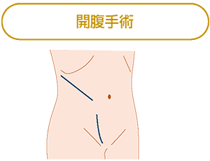 開腹手術