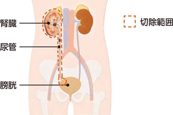 腎尿管全摘除術・膀胱部分切除術による切除範囲