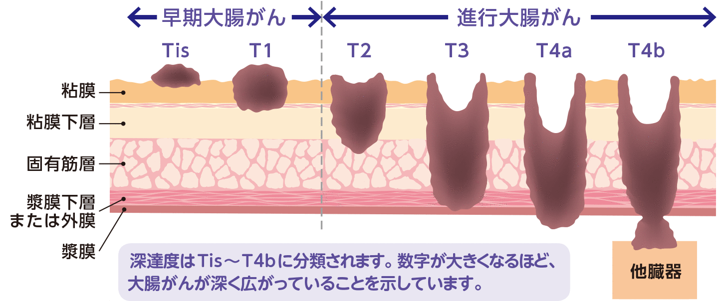 早期がんと進行がん