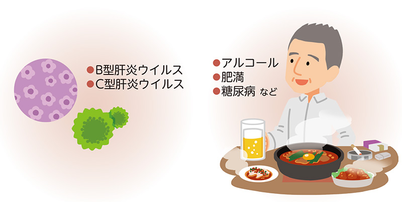 肝細胞がんの主な原因