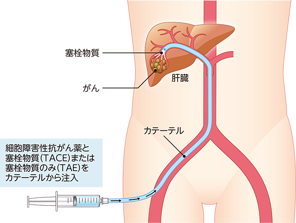 肝動脈塞栓療法（TAE）