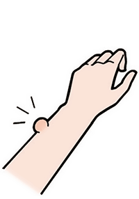 急に「いぼ」ができて、どんどん大きくなる