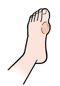 水ぶくれができる