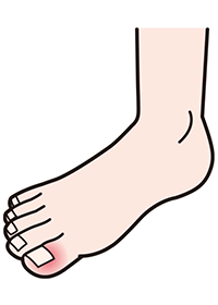 6週目頃～・爪のまわりの炎症